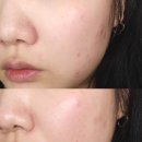 피지분비억제 홈케어 성인이마 얼굴여드름 피지웰 글로우 케어 부스터로 피부 관리 해본 후기