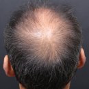 계양역 | 계양역탈모치료 후기｜주사치료 고민하다 탈모전문병원에서 관리 시작