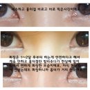 [수술후기] 앞트임흉터 & 복원 때문에 고생하시는 분들 위해 후기 써요 ! 이미지