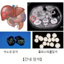 간내담석(IHD stone) 이미지