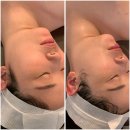 김해장유 윤곽리프팅온다 10만J 한번만으로 이중턱박살 후기! [골드테라피]