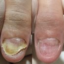 노란케어 119 | 노랗게 변한 손톱, 깨끗 케어 솔직 후기(잠실 내성발톱 전문 레푸스 잠실새내역점)