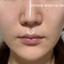 팔자좋은강아지 | 온다리프팅,팔자 필러 (리쥬비엘)7일차 후기(온다리프팅부작용 붓기, 부종 부작용 후기)