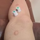 서울연합한의원 | 지긋지긋한 거위발건염 치료 후기!