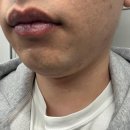 기대플러스병원 | 대구 피부과 젠틀맥스 프로 플러스 남자 수염 제모 1회차 내돈내산 리얼 후기 1만원의 행복