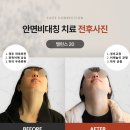 컬러나인한의원 | 안면비대칭 치료 전후 후기｜밸런스20 프로그램