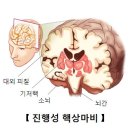 마비