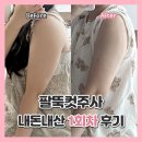 유라인의원 후기 팔뚝컷주사 1회차 내돈내산 팔뚝살빼기