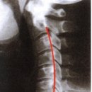 경추 증후군(CERVICAL SYNDROME) 이미지