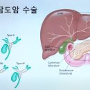 담도암의 수술 부위는 3개 영역으로 구분이 됩니다 이미지