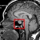 뇌하수체 분비성 종양 이미지