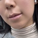 논현 온다리프팅 브이라인 턱선 찾은 후기