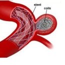 뇌동맥류 Cerebral aneurysm 뇌신경정신질환, 응급질환 증상 및 치료법 이미지