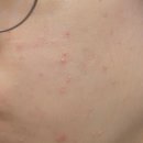 대성약국 | [부천 타임의원] 점, 쥐젖, 비립종, 편평사마귀, 잡티 제거 레이저 치료 성지 피부과 내돈내산 후기