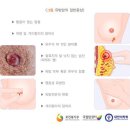 10년전 유방암환자가 폐암으로 전이되어 수술한 경우 암수술비와 암진단비를 받을 수 있습니까? 이미지