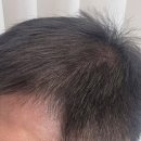 채도스칼프 이미지