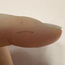 M-3 | [여자 M자 비절개 모발이식 후기 3탄] 모발이식 3주차~3개월 암흑기 탈락부터 잔머리 자라기까지