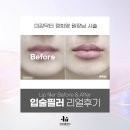 6389 | 압구정역 이유클리닉 미감닥터 정희영 원장의 입술필러 Before &amp; After 후기