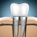 미라인치과의원 | 서울 중구 황학동 임플란트 치과 가격 비용 싼 곳,저렴한 곳,잘하는 곳,유명한 곳 BEST9 추천