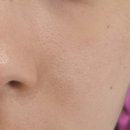 계양구 피부과 차명수 연세피부과의원 기미, 주근깨, 잡티제거 레이저 후기