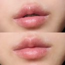 강남 | 입술필러 전후 후기 강남역피부과 녹이기