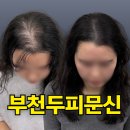 부천두피문신후기, 10년의 고민 3주간의 변화