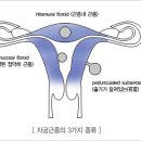 자궁근종 이미지