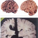 뇌경색에 의한 치매 이미지