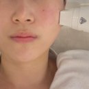 트로피피부과의원 | 대구리프팅추천 원쎄라,써마지 오하이스킨 후기