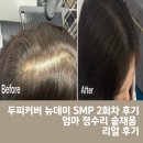 헤어뉴데이 | 두피커버 뉴데이 SMP 2회차 후기 엄마 정수리 숱채움 리얼 후기