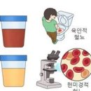 소변 색깔 원인 단백뇨 혈뇨 거품뇨 이미지