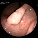 다양한 모양의 tubular adenoma 이미지