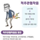 척추관 협착증 이미지