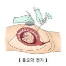 척수소뇌성 운동실조증[Spinocerebellar ataxia, SCA]뇌신경정신질환, 유전질환 이미지