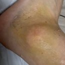효성전자 | [효성시티병원 수술 후기] 발목인대 완전 파열 진단 및 수술부터 입원 장단점