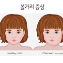 볼거리 증상 전염 볼거리 원인 치료 이미지