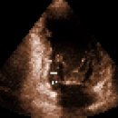 심장 초음파-벽운동 장애 Right coronary artery akinesia 이미지