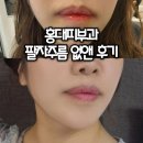 홍대언니 - 원주시 단관길 67-3 | 홍대피부과 홍대실리프팅 후기/요즘 핫한 중안부 리프팅으로 팔자주름 없앤 후기