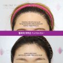 티포인트성형외과의원 | 모발이식 후 헤어라인이 어색하다면? 자연스럽게 교정한 헤어라인 재수술 후기