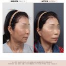 플레인의원 | 대전 딥플레인 안면목거상 한 달 후 변화, 리얼 후기