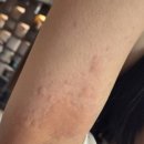 인하대학의대부속병원 | 상하이 교통대 응급실 방문 후기: 두드러기에 약처방 | 항히스타민제와 수액..