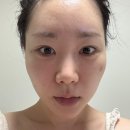 나비존 모공 스트레스로 포텐자 스킨부스터 7번 한 후기 (찐후기 들려드림..)