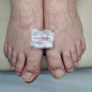 고양메디컬의원 | “파주·일산 발톱무좀. 손발 무좀·내성발톱 동시치료 성공 사례”메디컬오의원일산점