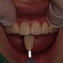 오름치과기공소 | 예쁘게 치료하기 어려운건 앞니 1개짜리 통지르코니아 싱글 크라운, 색맞추기도 어렵고 대칭 모양도 어렵다