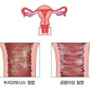 칸디다성 외음질염[Candidal vulvovaginitis]여성질환 이미지