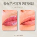 리턴헤어 | 입술문신 반영구 화장 지우는 방법 / 리턴세럼 잔흔제거 효과 후기 광주 수완지구