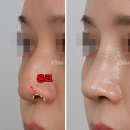 용코교정, 비공내리기 수술 통해 솟은 콧구멍 개선!