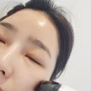 미인 | 프락셔널 레이저 고주파 디바이스 퓨라셀미인 후기