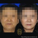 13년전 수술한 분의 안면거상 재수술