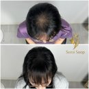 우림카이저팰리스아파트경로당 | 탈모고민 해결방법! 인천 두피문신 SMP 잘하는 곳 추천